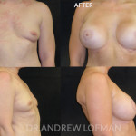 Before and after breast augmentation with lift 3
