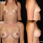 Before and after breast augmentation 2