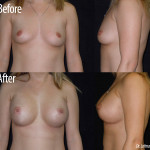 Before and after breast augmentation front and side view case 4