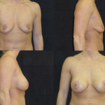 Before and after breast lift 2