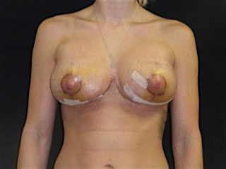 Post op breast implant with lift