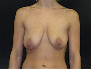 Before breast implant with lift