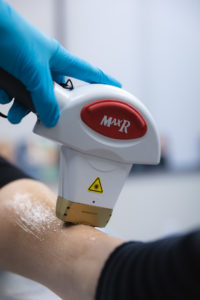 Laser hair removal on legs Dr. Lofman Bloomfield Hills, MI