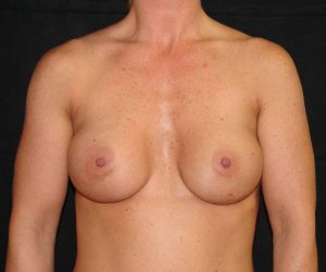 after breast augmentation front view female patient case 3600