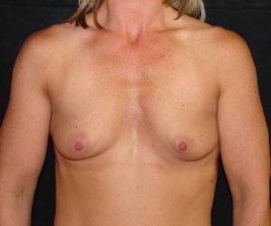 before breast augmentation front view female patient case 3600