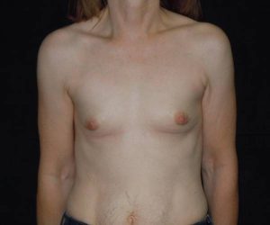 before breast augmentation front view female patient case 3620