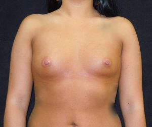 before breast augmentation front view female patient case 3646