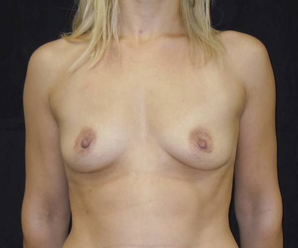 before breast augmentation front view female patient case 3676