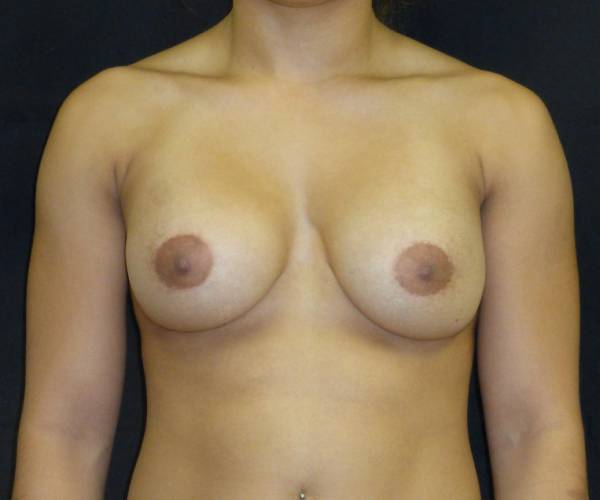 after breast augmentation front view female patient case 3691