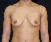 before breast augmentation front view female patient case 3691