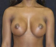 after breast augmentation front view female patient case 3701