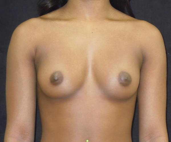 before breast augmentation front view female patient case 3701