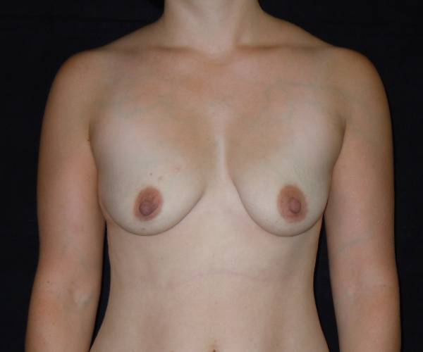 before breast augmentation front view female patient case 3711