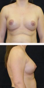 after breast augmentation front & right view female patient case 3763