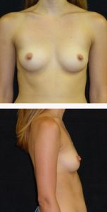 before breast augmentation front & right view female patient case 3771
