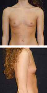 before breast augmentation front & right view female patient case 3776