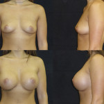 Before and after breast augmentation