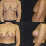 Before and after breast augmentation front and side view case 11