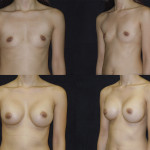 Before and after breast augmentation front and side view case 9