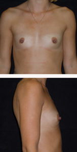 Before breast augmentation front and side view case 12