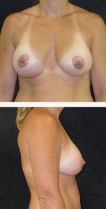 after breast augmentation with lift front and side view case 11