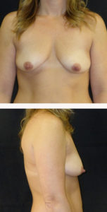 Before breast augmentation with lift front and side view case 11