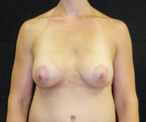 after breast augmentation with lift front view female patient case 3801