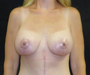 after breast augmentation with lift front view female patient case 3806