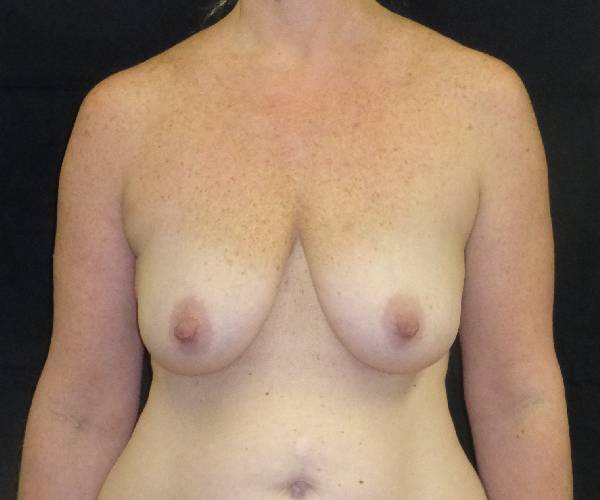 before breast augmentation with lift front view female patient case 3856