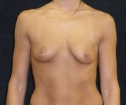 before breast augmentation with lift front view female patient case 3891