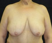 before breast lift front view female patient case 3570