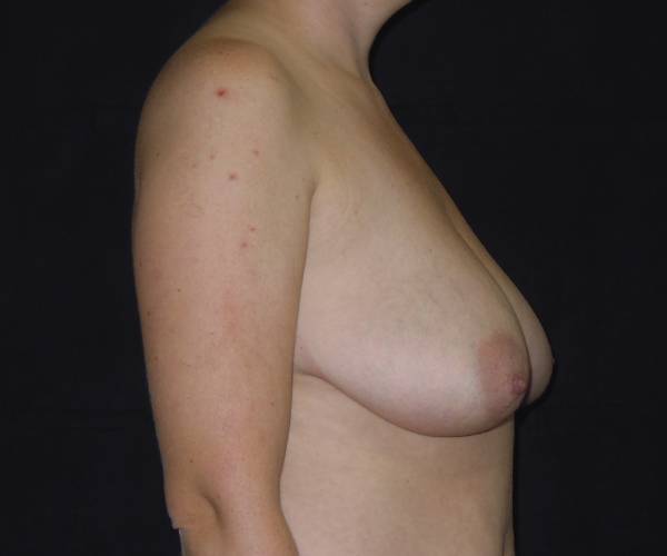 before breast lift right view female patient case 3580