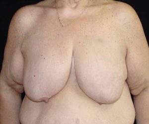 before breast reduction front view female patient case 3896
