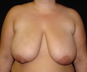 before breast reduction front view female patient case 3901