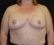 after breast reduction front view female patient case 3936