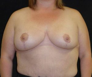 after breast reduction front view female patient case 3936