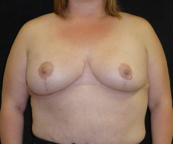 after breast reduction front view female patient case 3936