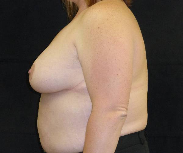 after breast reduction left view female patient case 3936