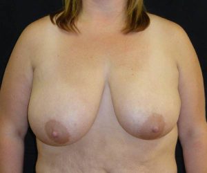 before breast reduction front view female patient case 3936