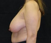 before breast reduction left view female patient case 3946