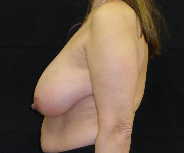 before breast reduction left view female patient case 3946