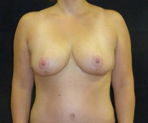 after breast reduction front view female patient case 3951