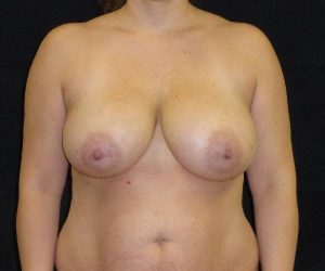 before breast reduction front view female patient case 3951