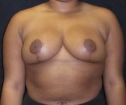 after breast reduction front view female patient case 3956