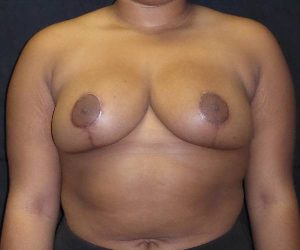 after breast reduction front view female patient case 3956
