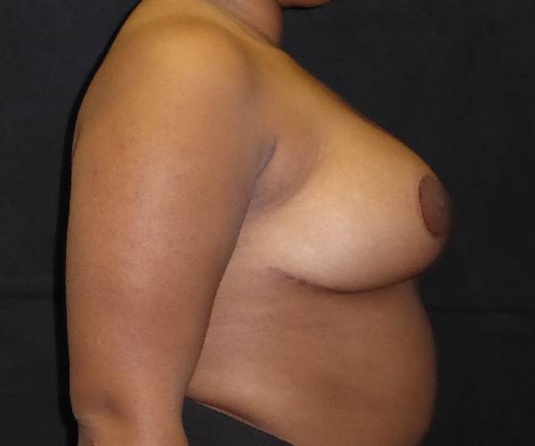 after breast reduction right view female patient case 3956