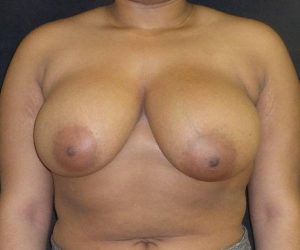 before breast reduction front view female patient case 3956