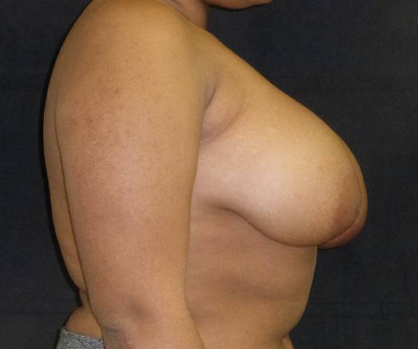 before breast reduction right view female patient case 3956