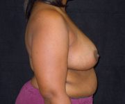 after breast reduction right view female patient case 3977