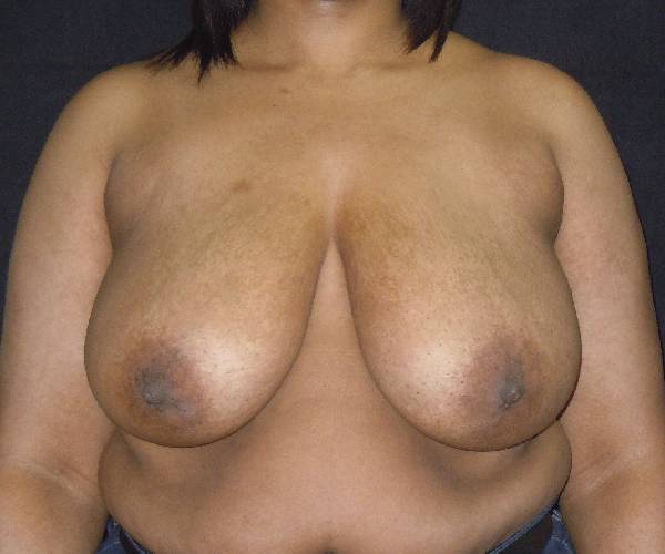 before breast reduction front view female patient case 3977